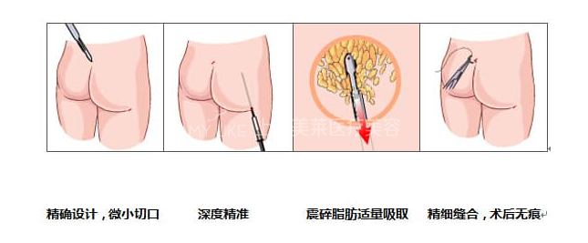 手术过程