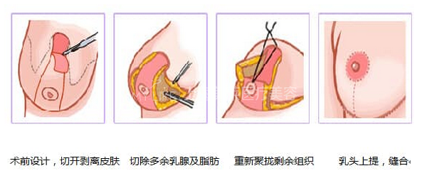 巨乳缩小示意图