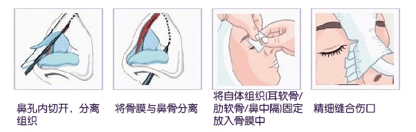 隆鼻过程