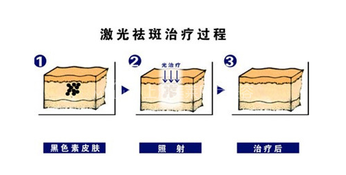 激光祛斑