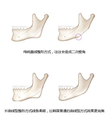 下颌角整形