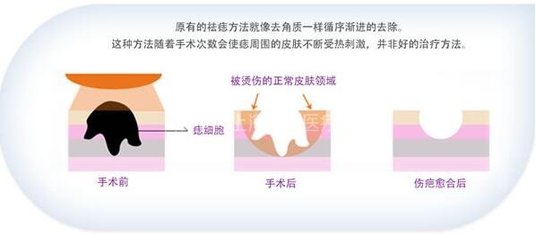 美莱激光祛太田痣有哪些优势