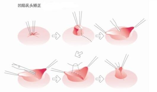 乳头内陷治疗