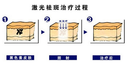 激光祛斑