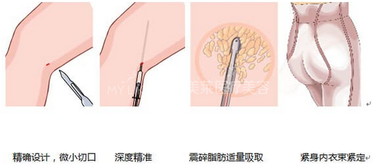 腿部吸脂术