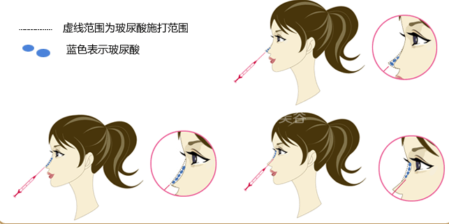 来说说你喜欢隆鼻手术的理由是什么